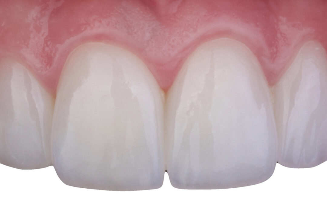Guía completa sobre carillas dentales: beneficios, proceso y cuidados para tu mejor sonrisa