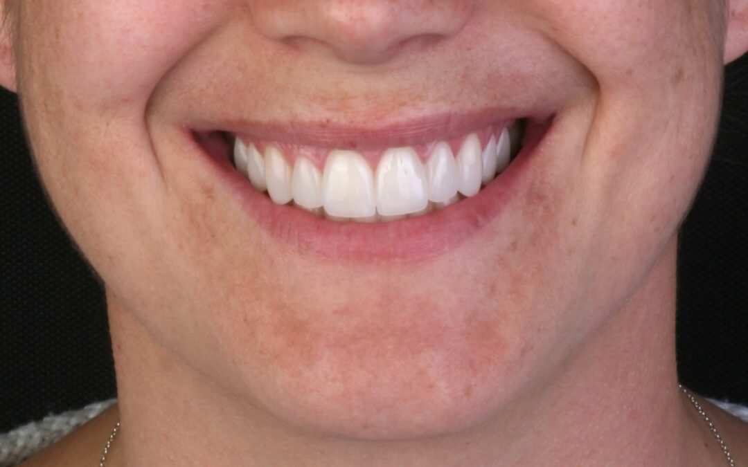 Guía práctica: cómo un diagnóstico personalizado mejora el éxito de tus carillas dentales