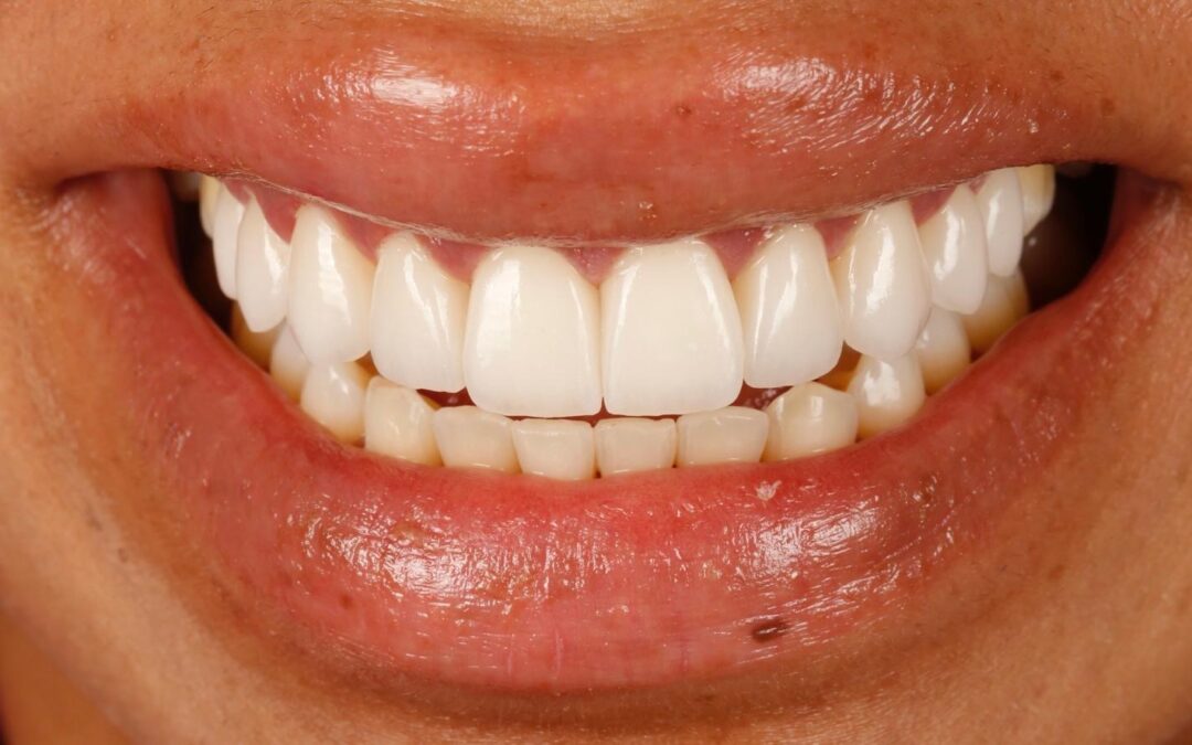 Por qué el diagnóstico personalizado es la clave de un diseño de sonrisa con carillas realmente óptimo