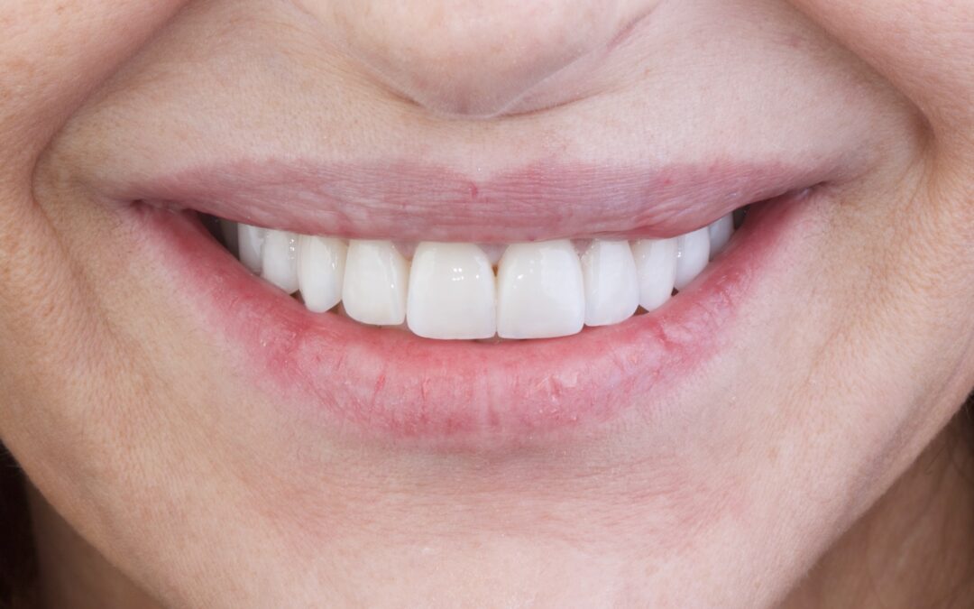 Carillas dentales mínimamente invasivas: qué son, para quién están indicadas y qué ventajas ofrecen