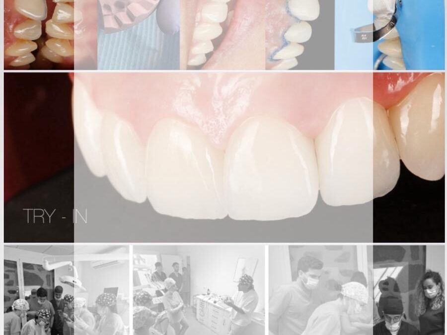 Planificación de un diseño de sonrisa mínimamente invasivo: diagnóstico, objetivos y criterios clínicos