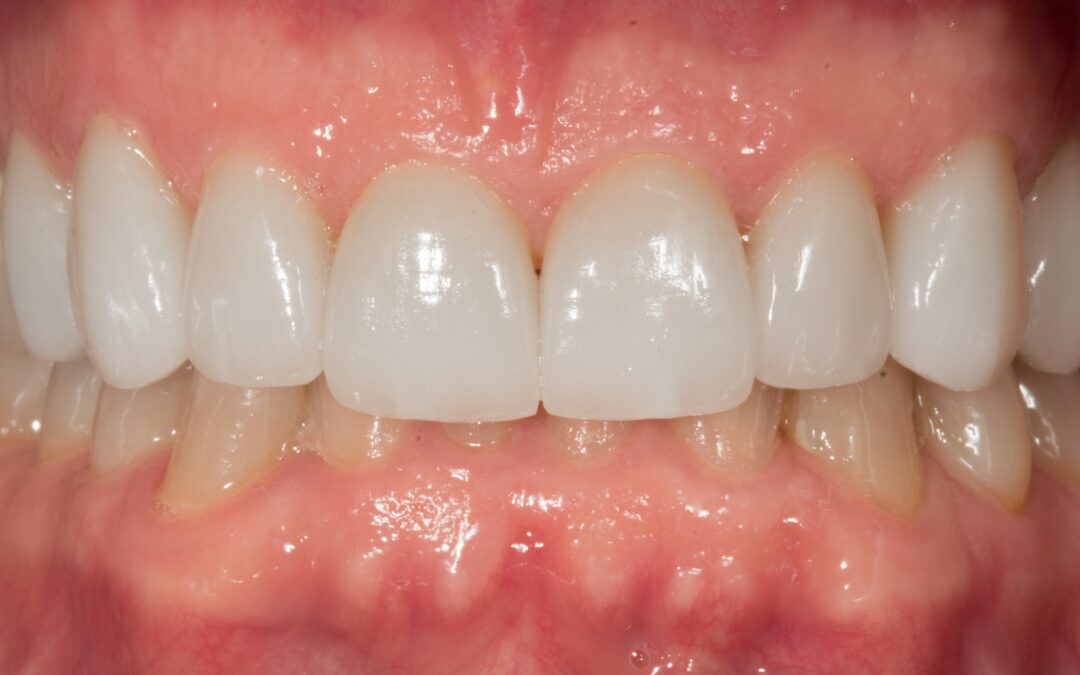 Cómo elegir un tratamiento de estética dental conservador sin renunciar a una sonrisa armónica